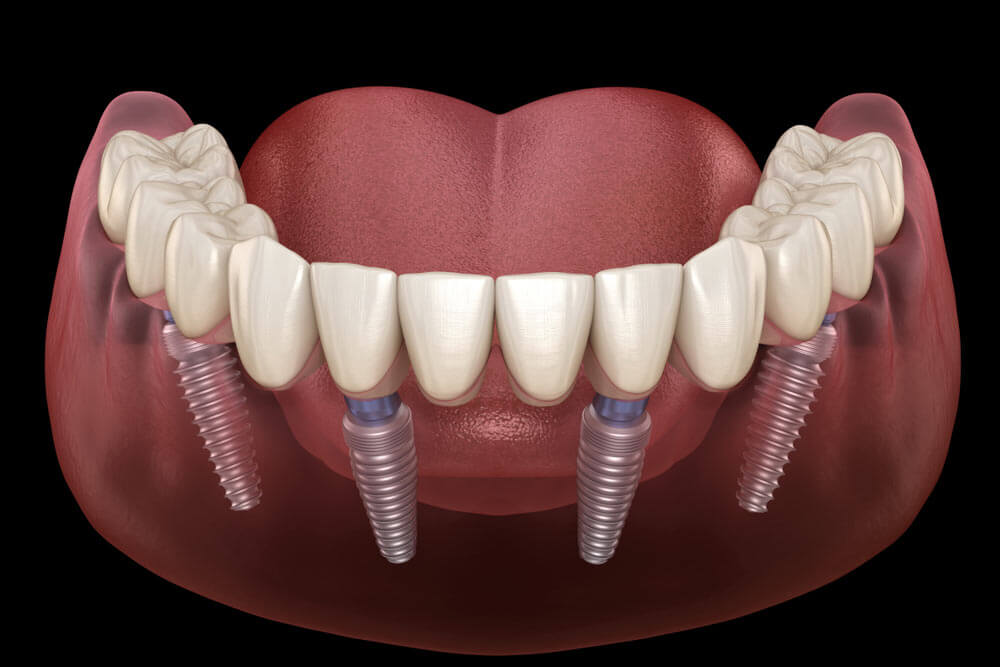 All On 4 Implant Supported Dentures 