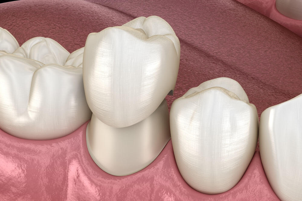 Crowns showing the concept of General Dentistry