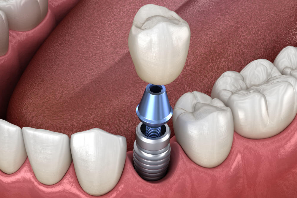 Dental implants showing the concept of Home